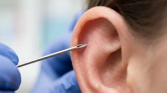 Gros plan sur le cartilage d'une oreille percé avec une aiguille chirurgicale professionnelle
